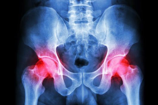 human's pelvis and arthritis at both hip joint (Gout,Rheumatoid) Wall Mural