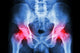 human's pelvis and arthritis at both hip joint (Gout,Rheumatoid) Wall Mural