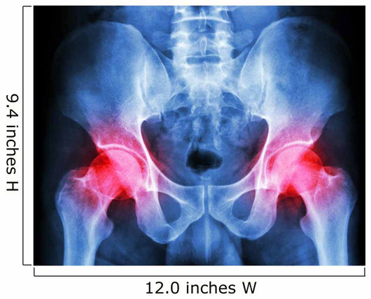 human's pelvis and arthritis at both hip joint (Gout,Rheumatoid) Wall Mural