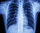 x-ray chest Wall Mural
