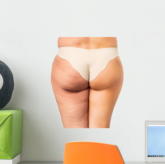 Cellulite treatment, before and after Wall Decal