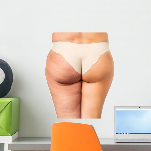 Cellulite treatment, before and after Wall Decal
