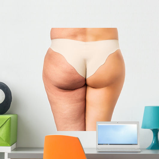 Cellulite treatment, before and after Wall Decal