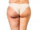 Cellulite treatment, before and after Wall Decal
