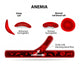anemia diagram Wall Mural