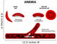 anemia diagram Wall Mural