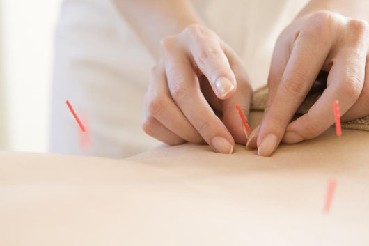 Women Undergoing Acupuncture Waist Wall Decal