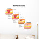 wound healing diagram Wall Decal