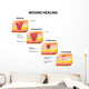 wound healing diagram Wall Decal