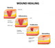 wound healing diagram Wall Decal