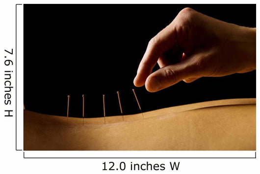 Acupuncture Wall Decal