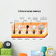 acne pimple types Wall Decal