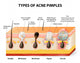 acne pimple types Wall Decal