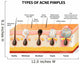 acne pimple types Wall Decal