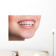 Woman with teeth braces Wall Mural