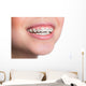 Woman with teeth braces Wall Mural