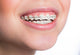 Woman With Teeth Braces Wall Decal