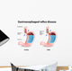 Gastroesophageal Reflux Disease Wall Decal