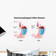 Gastroesophageal Reflux Disease Wall Decal
