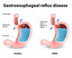 Gastroesophageal Reflux Disease Wall Decal