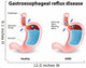Gastroesophageal Reflux Disease Wall Decal