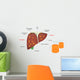 Alcohol Related Liver Disease Wall Decal