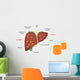 Alcohol Related Liver Disease Wall Decal
