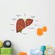 Alcohol Related Liver Disease Wall Decal
