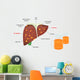 Alcohol Related Liver Disease Wall Decal