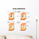Acne Formation Wall Decal