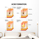 Acne Formation Wall Decal