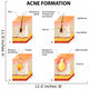 Acne Formation Wall Decal