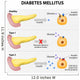Diabetes Mellitus Wall Decal