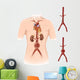 Artist Depiction Abdominal Aortic Wall Decal Design 2