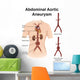 Artist Depiction Abdominal Aortic Wall Decal Design 1