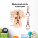Artist Depiction Abdominal Aortic Wall Decal Design 1