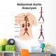 Artist Depiction Abdominal Aortic Wall Decal Design 1
