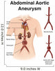 Artist Depiction Abdominal Aortic Wall Decal Design 1