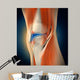 Medical Illustration Showing Inflammation Wall Decal Design 1