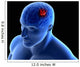 Conceptual Image Tumor Human Wall Decal